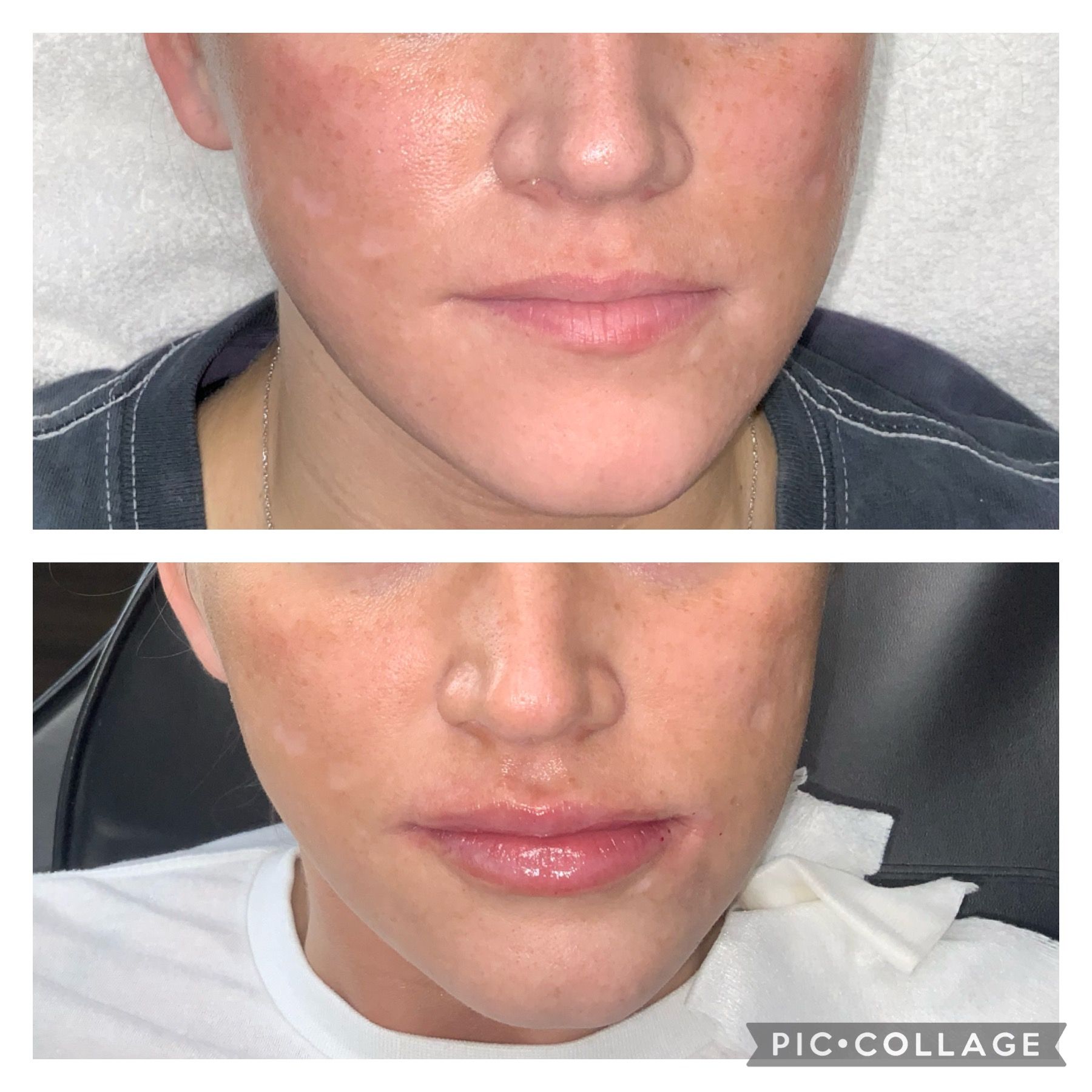 Two images: Before and after facial treatment. Woman's face shows reduced redness and improved lip appearance.
