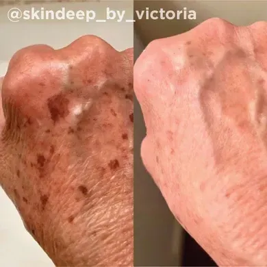 Hand showing before and after treatment for age spots: brown spots reduced.