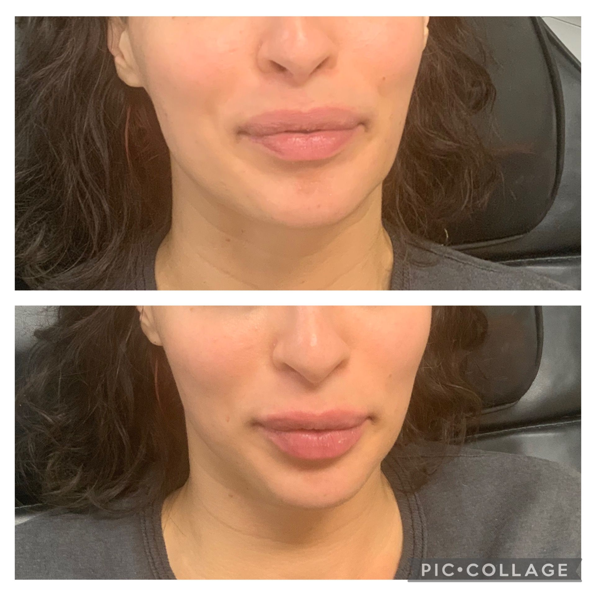 Before and after lip filler treatment: woman's lips fuller, more defined. Top: before; bottom: after.