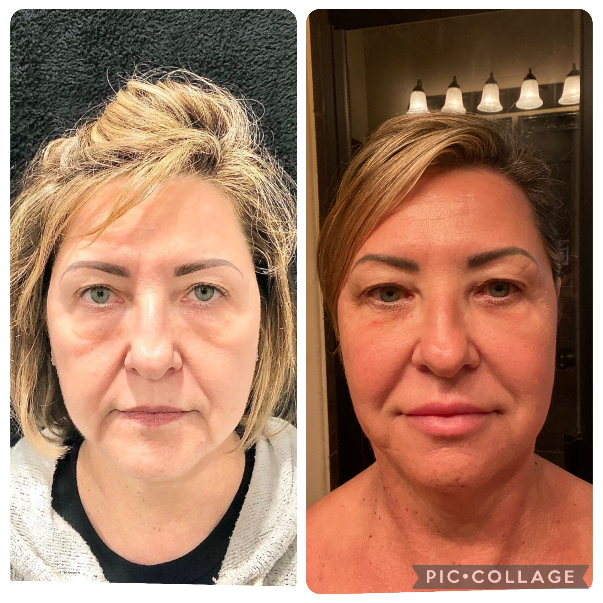 Before-and-after photos of a woman's face, showing a skin rejuvenation procedure.