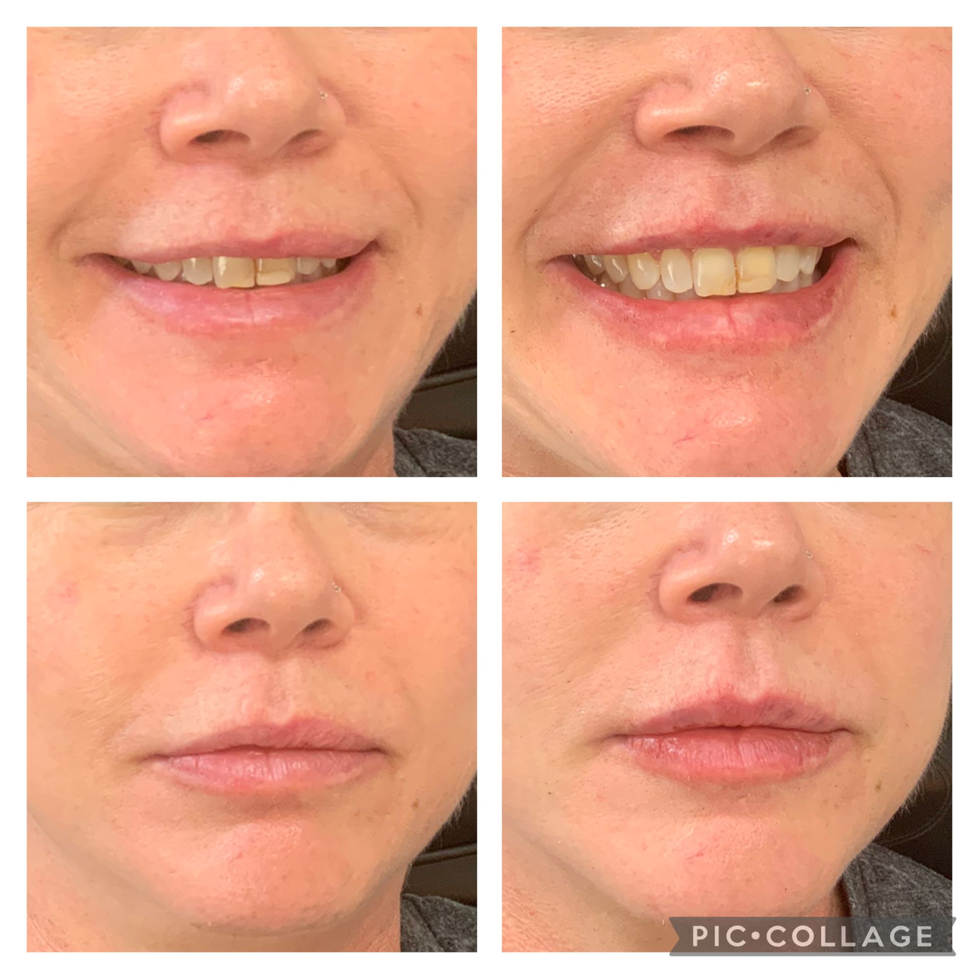 Four close-up photos of a person's mouth and lower face, showing expressions before and after lip filler.