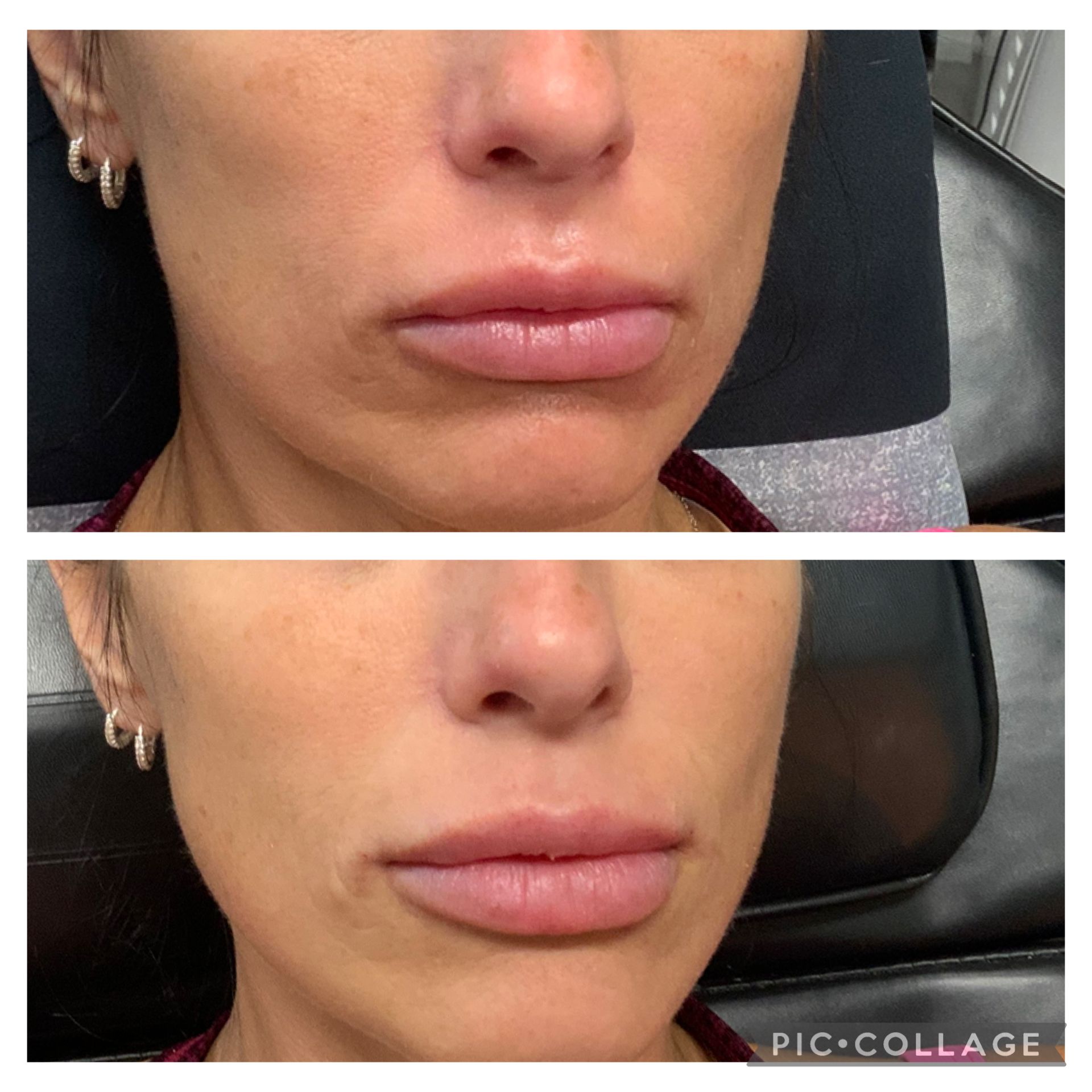 Top photo: woman with swollen lips. Bottom photo: lips less swollen.