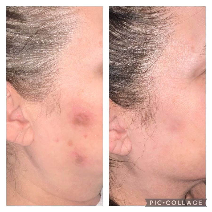 Before and after photos showing skin blemishes on cheek fading.