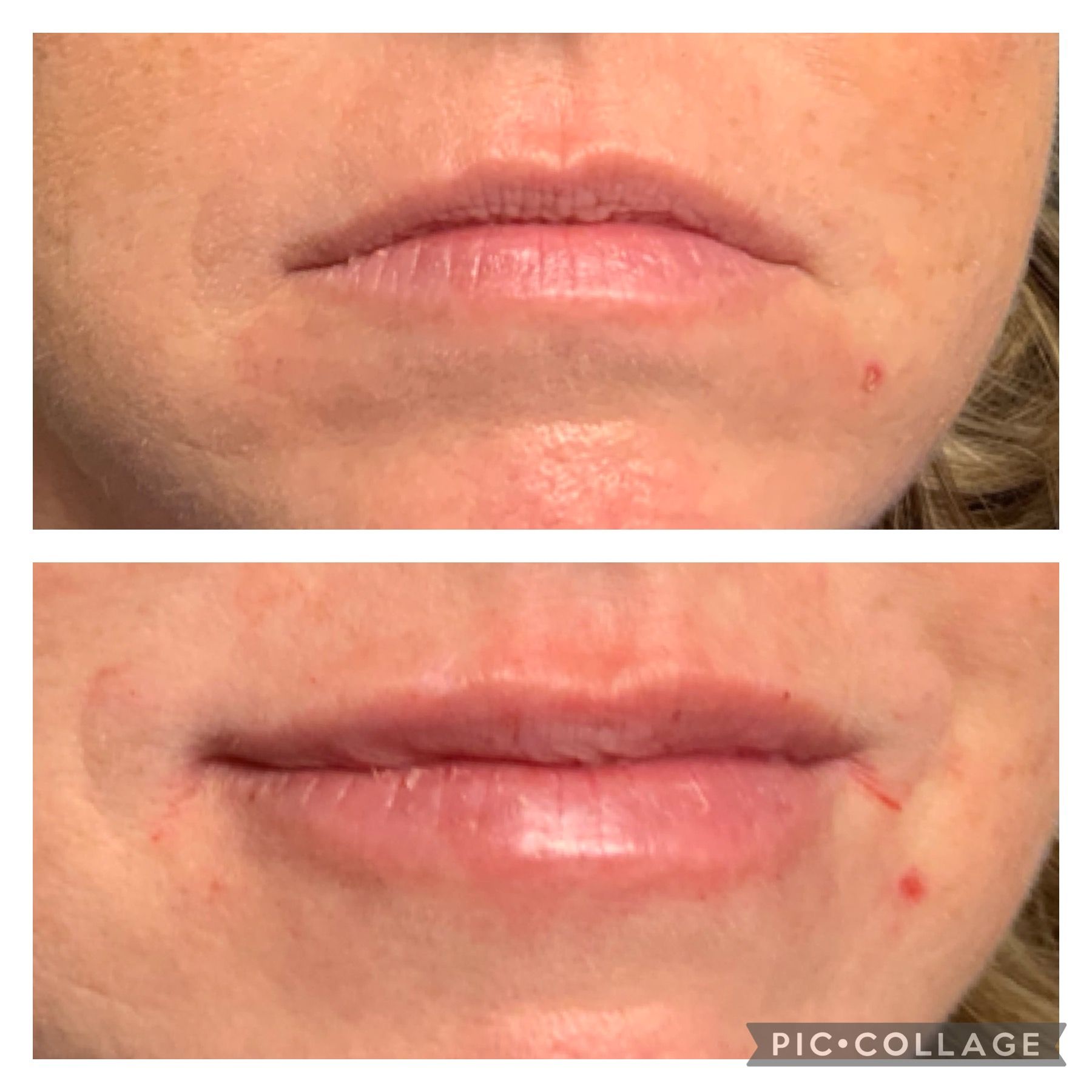 Before and after photos showing fuller lips after a cosmetic procedure.