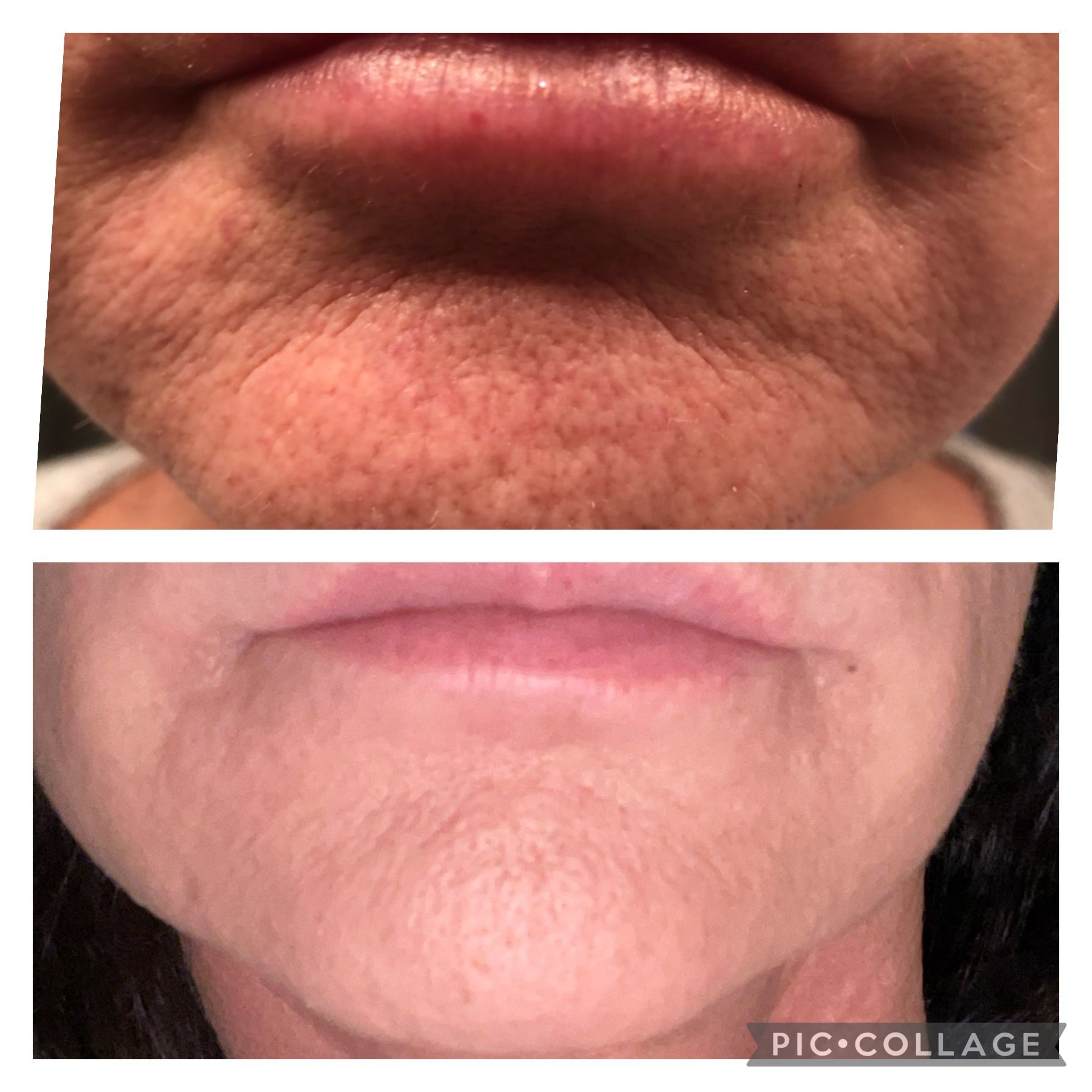 Before and after photos of a person's chin and lips. Top shows wrinkles, bottom shows smoother skin.