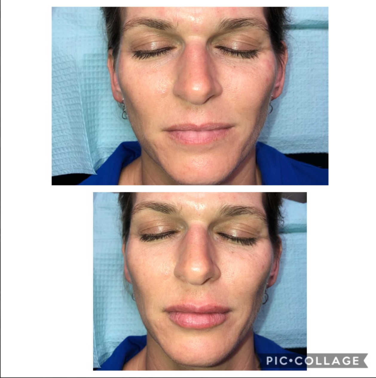 Before and after images of a woman's face, upper with closed eyes, lower with plumped lips.