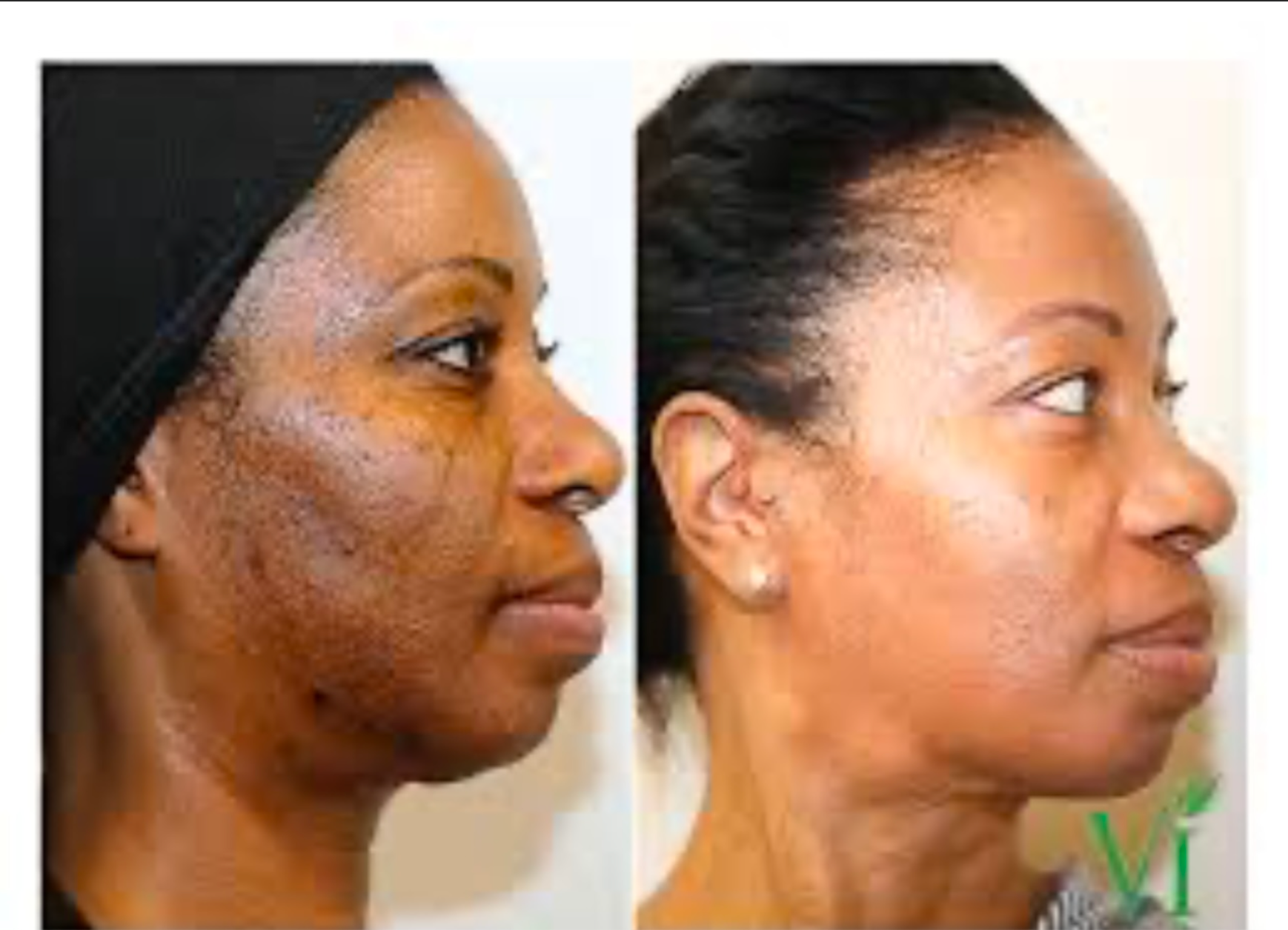 Before and after photos of a Black woman's face, showing a significant reduction in skin discoloration.