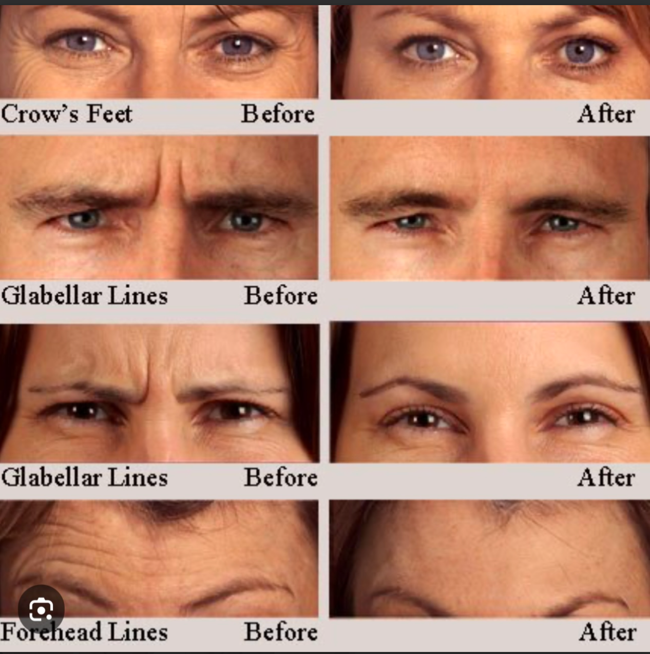 Before & after photos of eyes, showing reduction in wrinkles (crow's feet, glabella, forehead) after treatment.