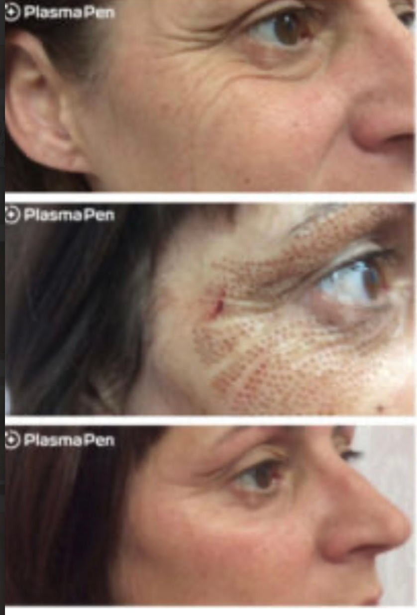 PlasmaPen treatment: Before, during, and after photos showing wrinkle reduction around the eye.