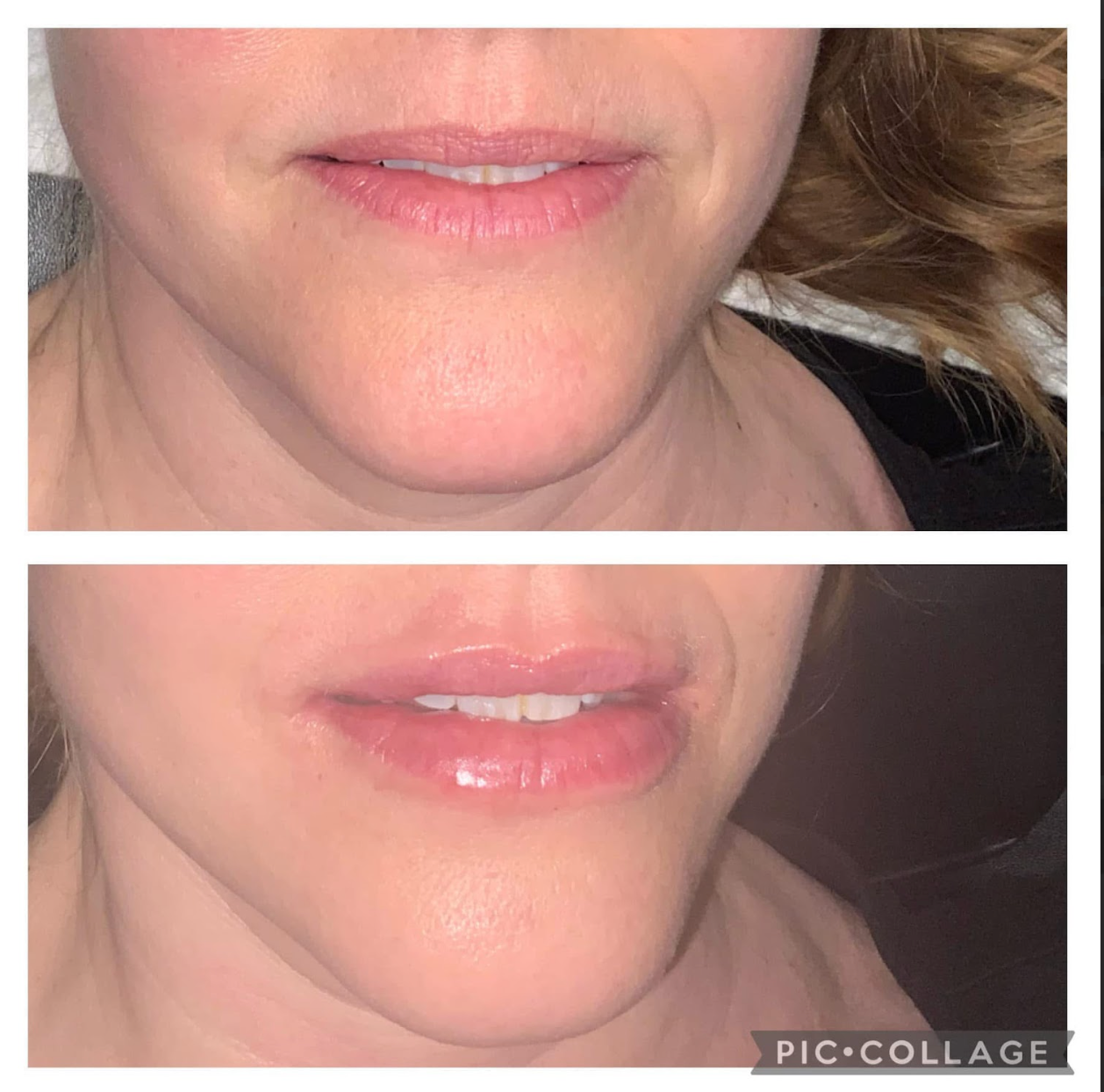 Before-and-after of woman's lips; top shows thinner lips, bottom shows fuller lips after lip filler.