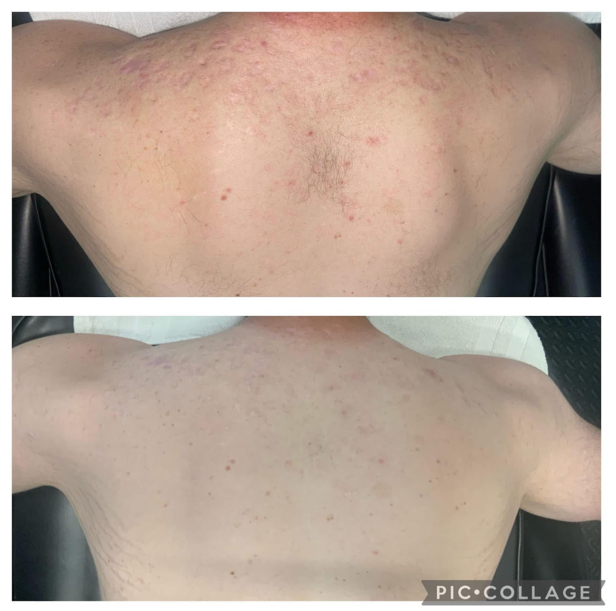 Before and after comparison of a person's back; top with red marks and bottom with less noticeable marks.