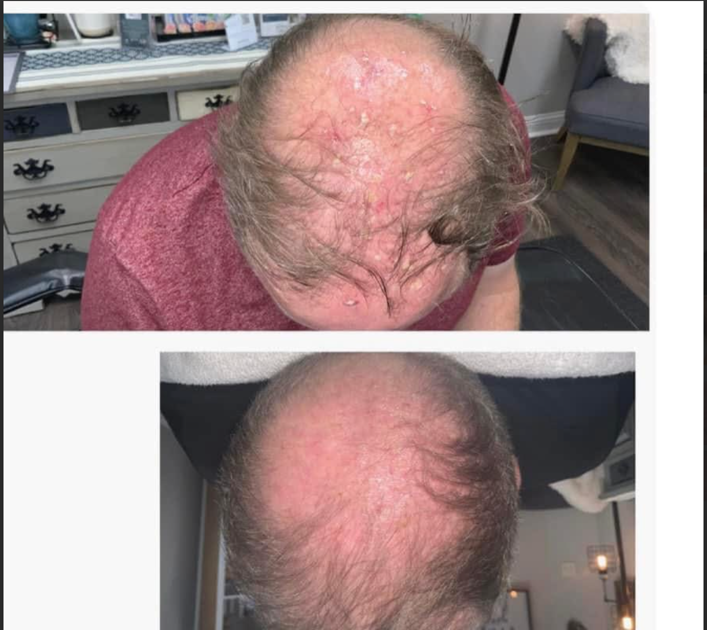 Top: Balding man with thin hair. Bottom: Hair growth on the same man.