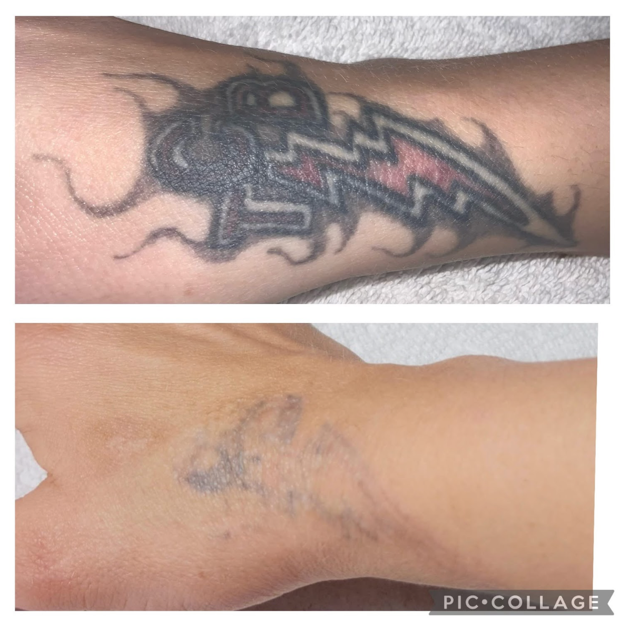 Before-and-after of tattoo removal; wrist with a black tribal tattoo, then faded skin with visible ink.
