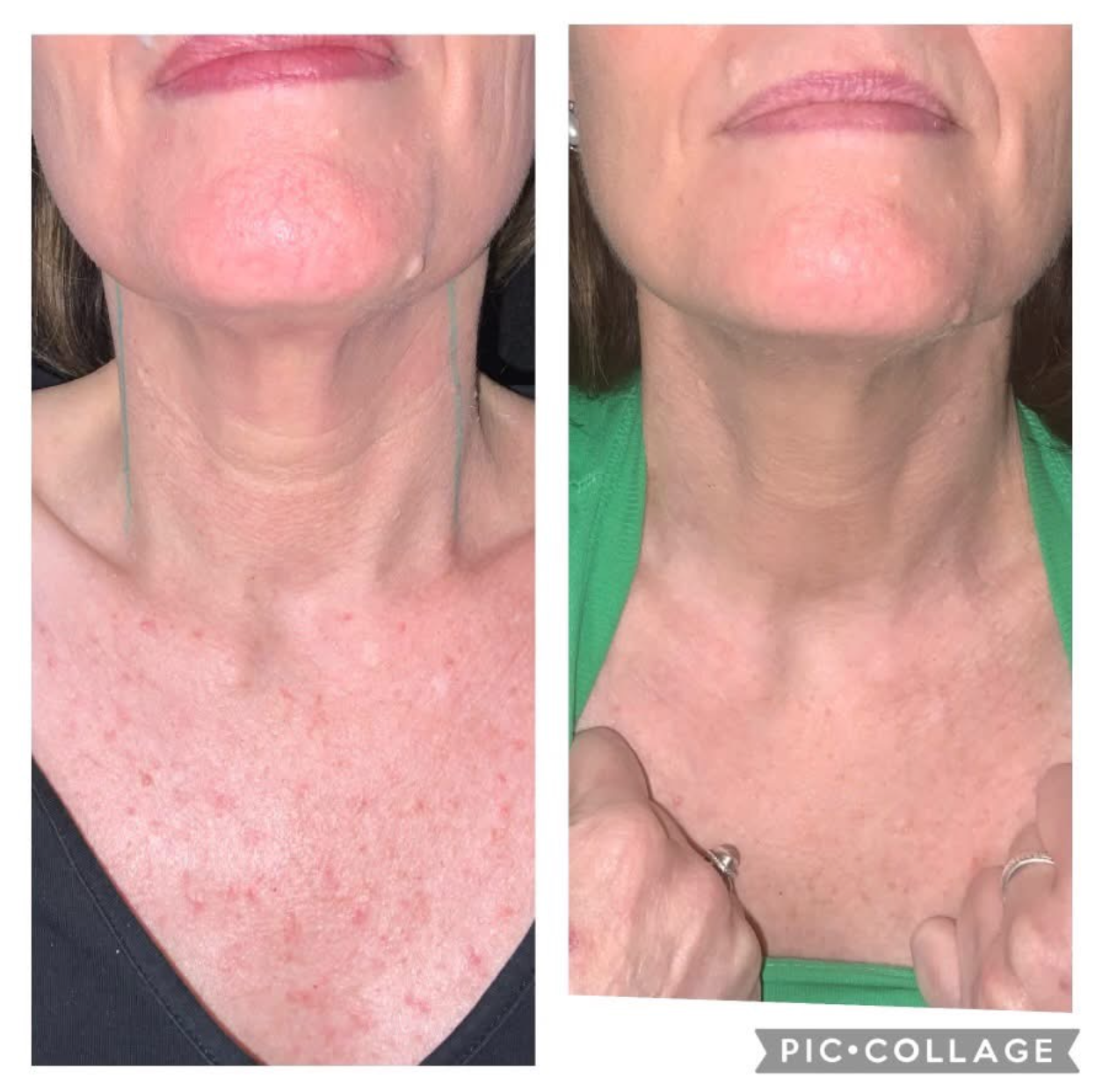 Before and after photos showing neck and chest rejuvenation; skin tone appears improved with reduced redness.
