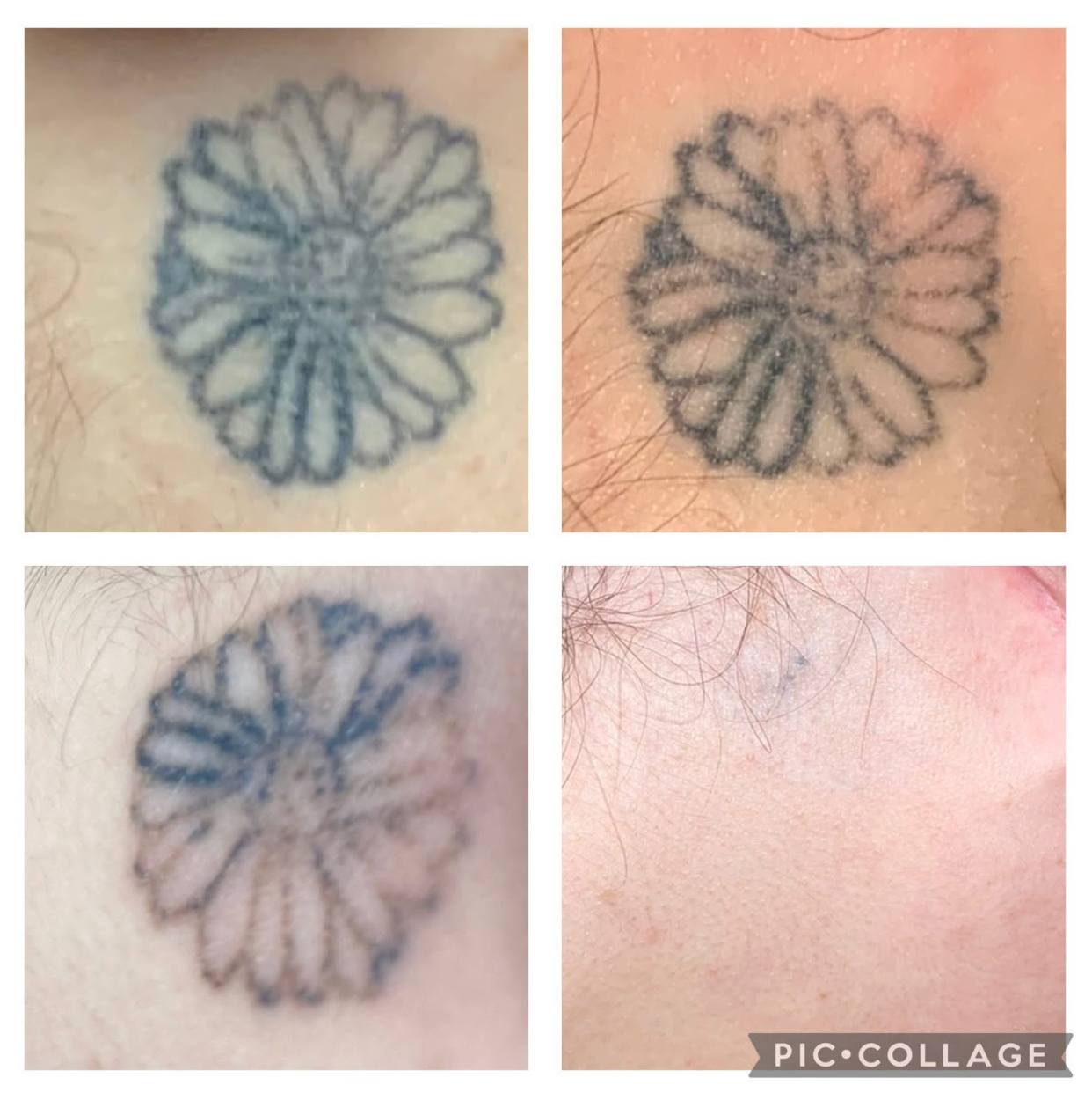 Four images show daisy tattoo fading over time, progressing from blue to near invisibility on skin.