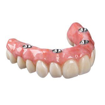 Implant Overdentures