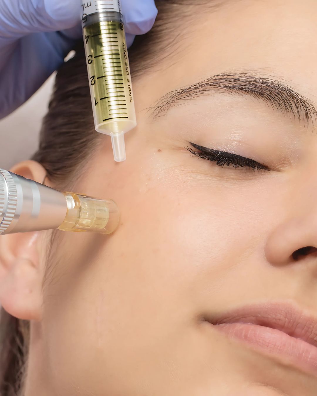 Microneedling met dermapen bij Sev Aesthetic voor het bevorderen van collageenproductie en het verbeteren van de algehele huidgezondheid