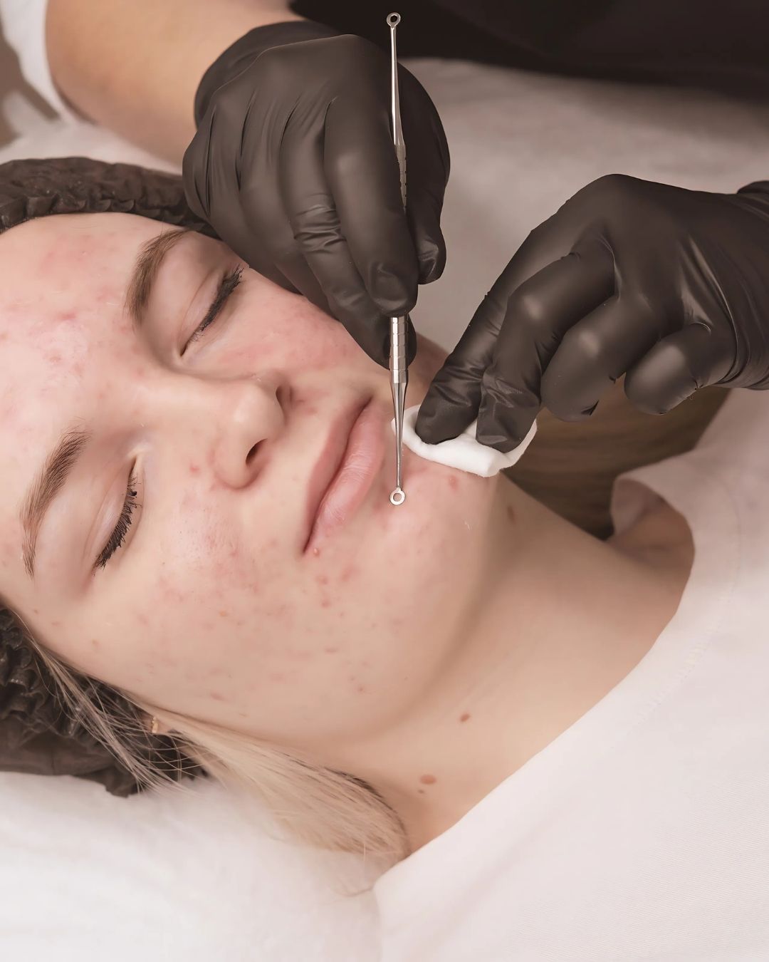 Acne therapie bij Sev Aesthetic voor het effectief behandelen van acne en verbeteren van de huid, met mogelijke vergoeding bij aanvullende verzekering