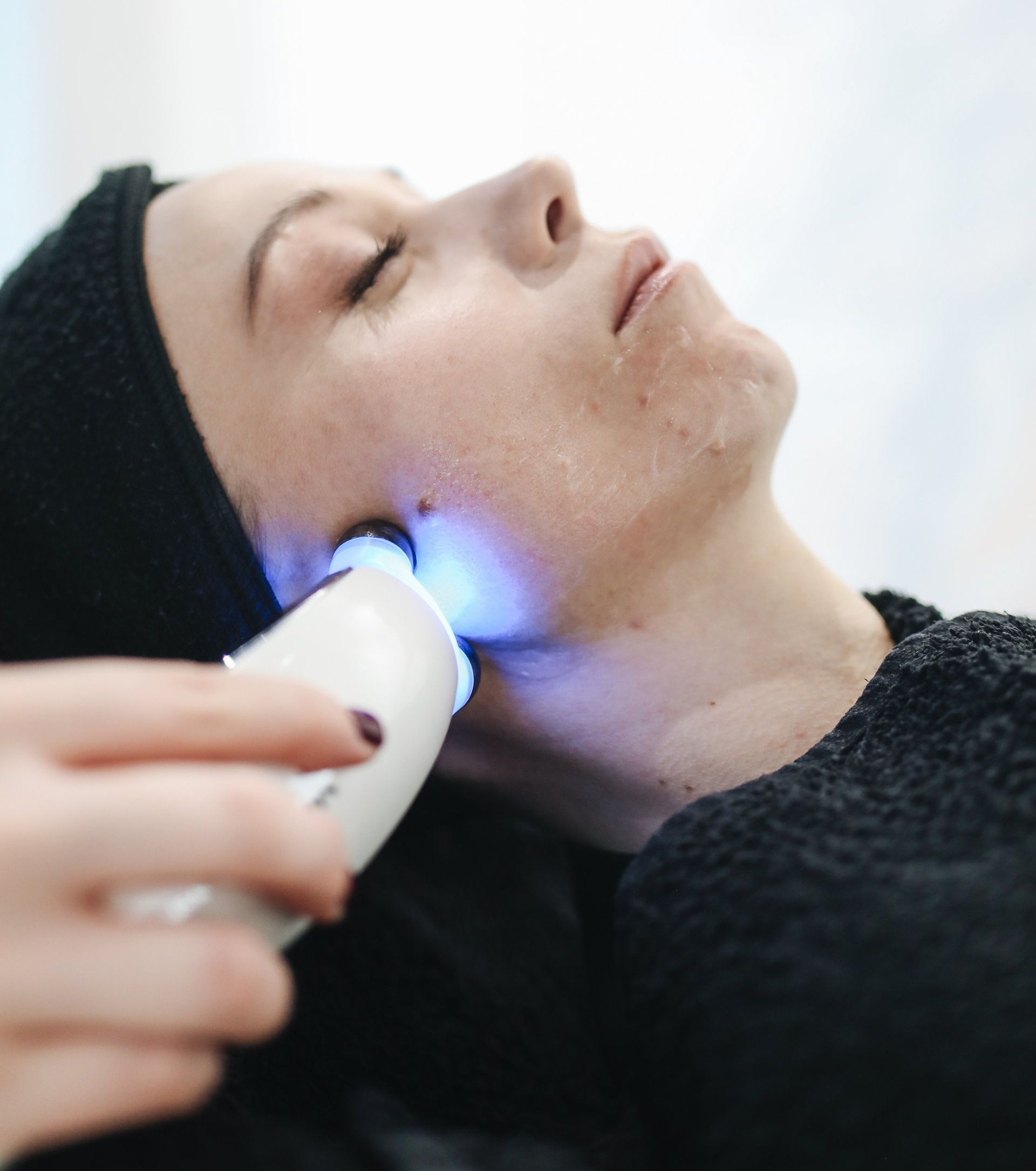 SEV Skin & Hair Aesthetic acne behandeling huidverbetering acne therapy