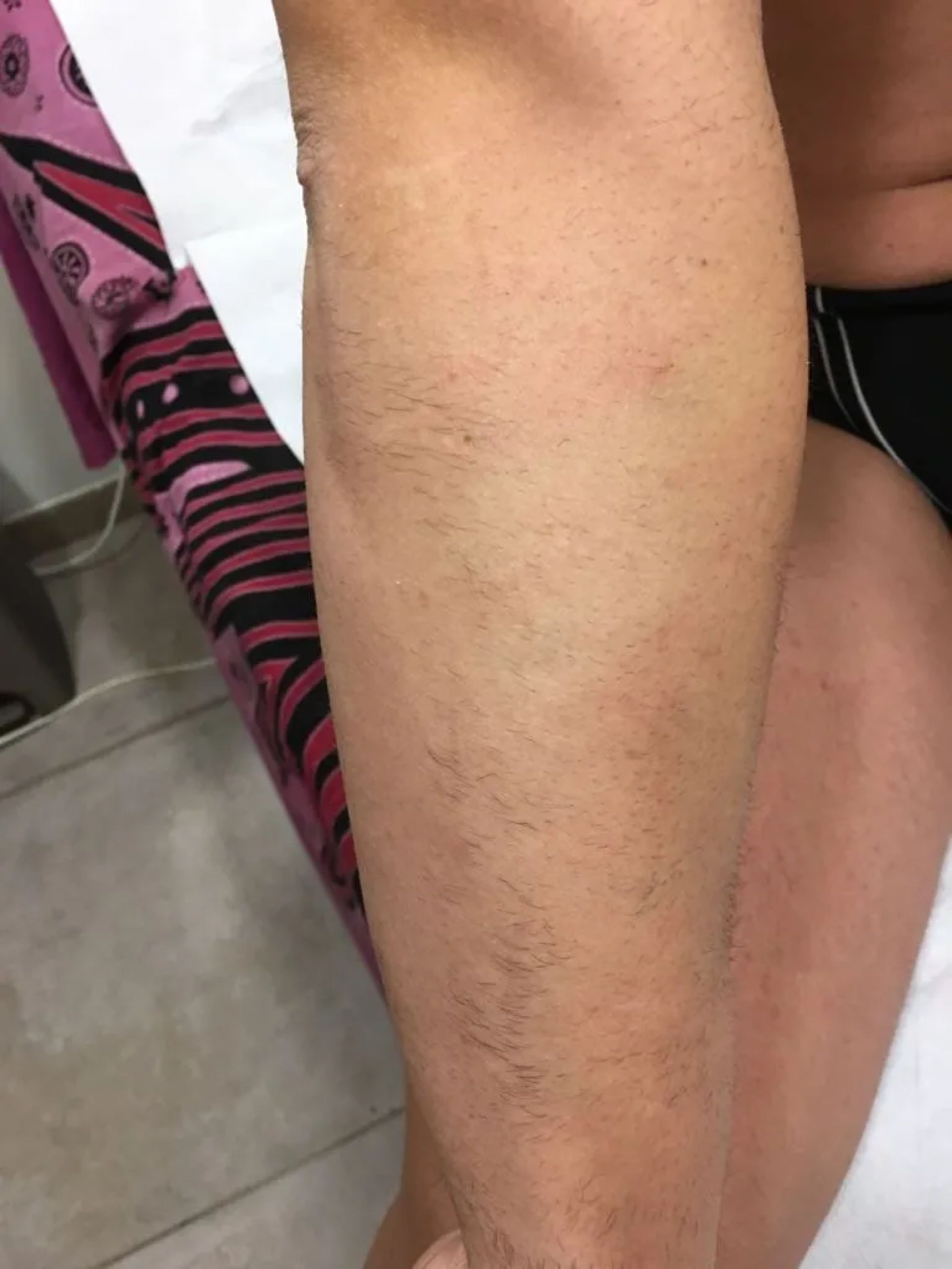 Depilazione avambraccio