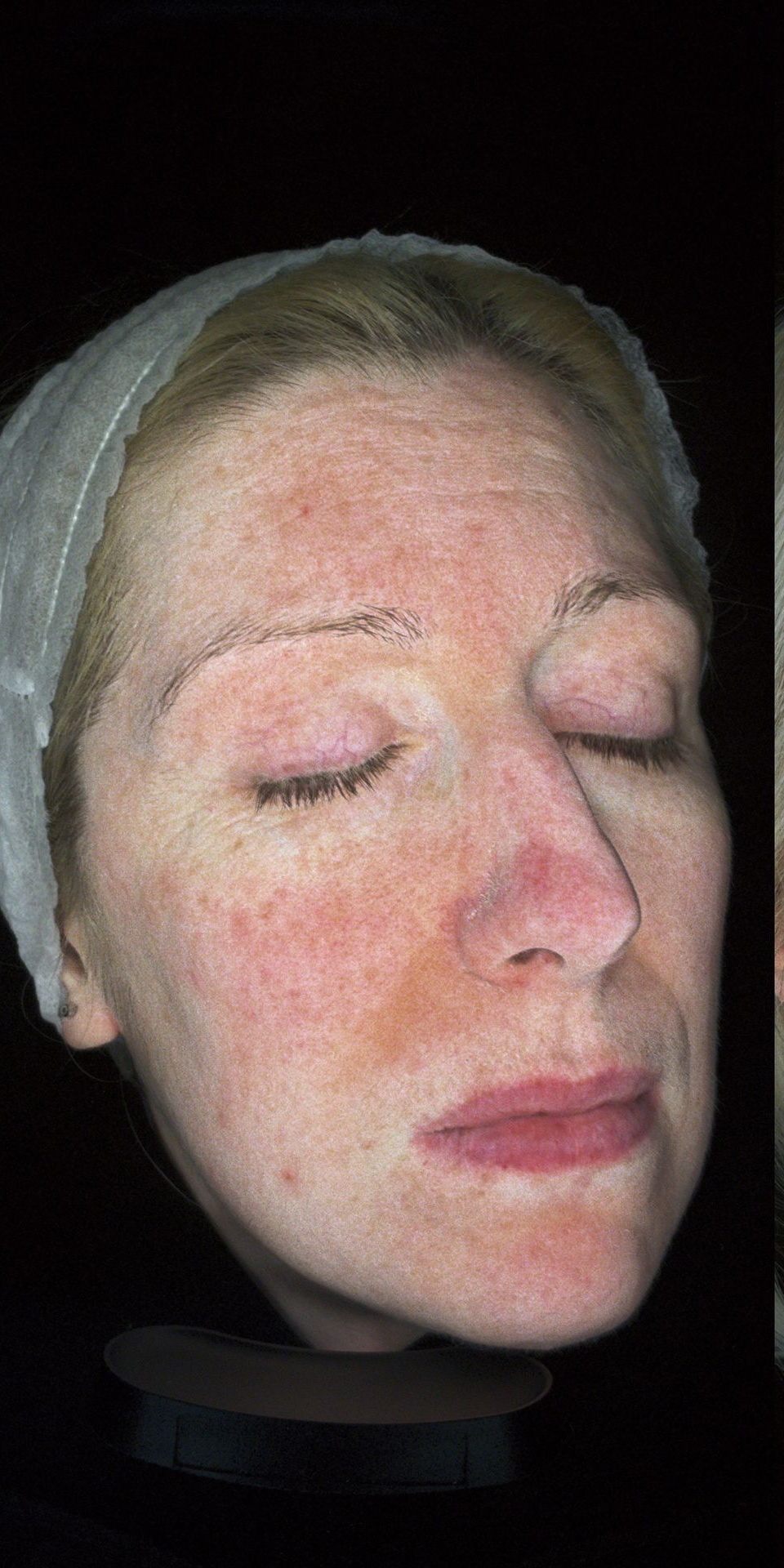 	Doctor-led chemical peel to reduce redness and improve skin tone- before 