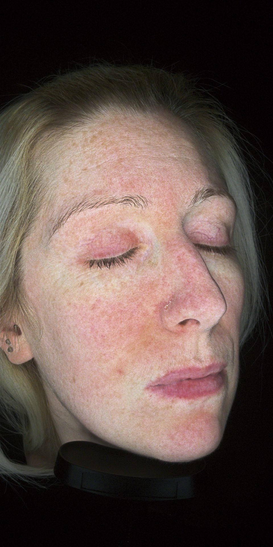 	Doctor-led chemical peel to reduce redness and improve skin tone- after 