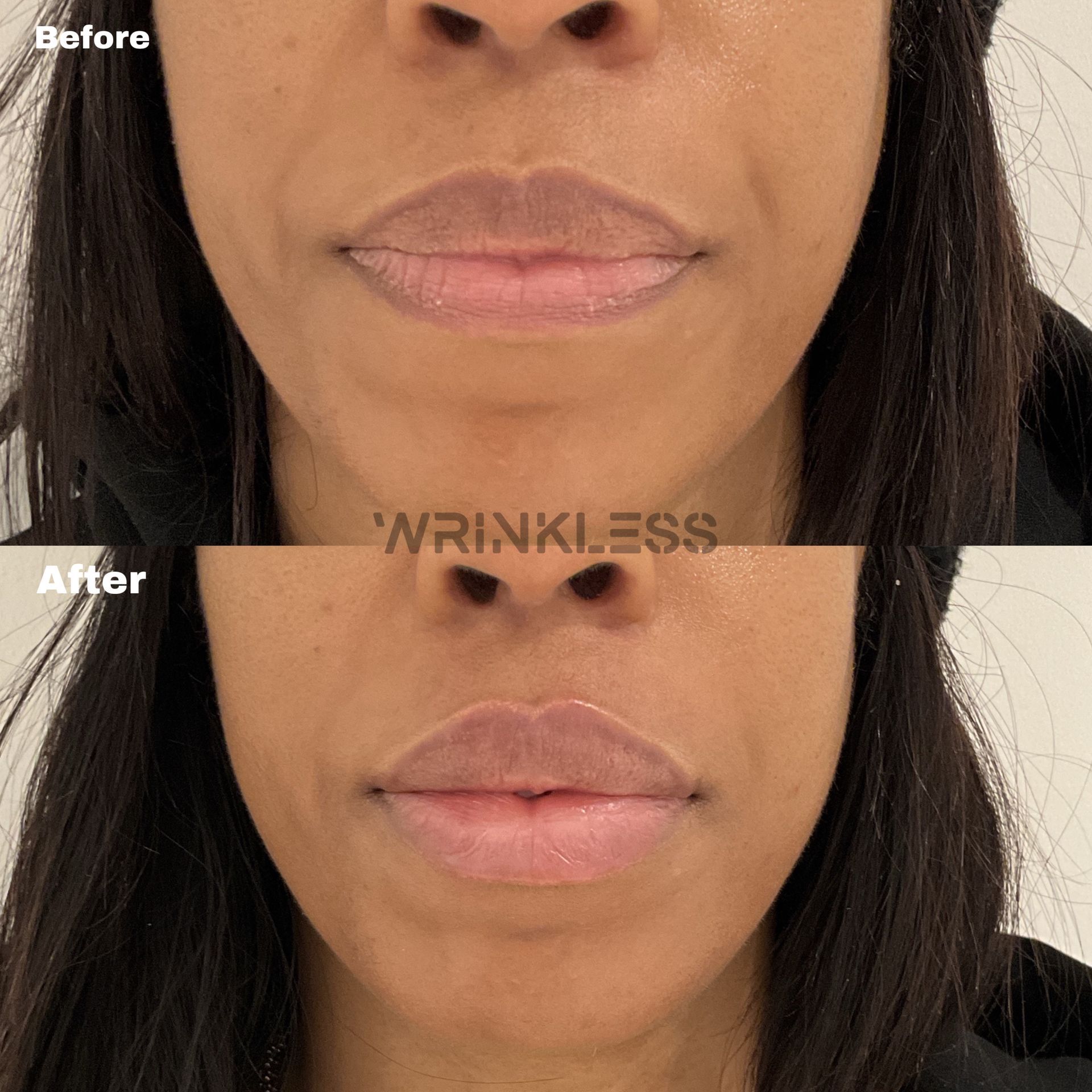 Anatomy-led lip filler treatment to enhance natural lip shape