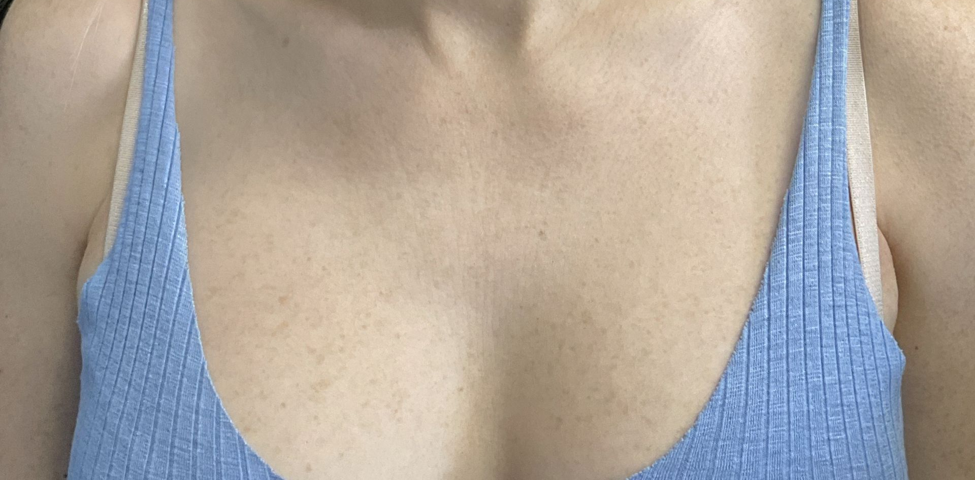 Chemical peel treatment for the chest to improve skin tone and texture- before 