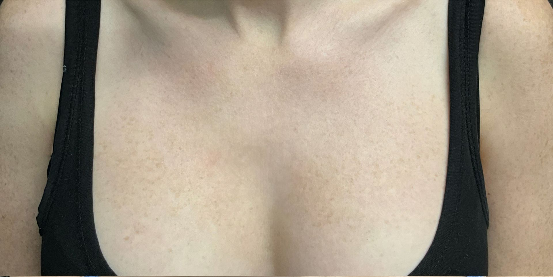 Chemical peel treatment for the chest to improve skin tone and texture- after 
