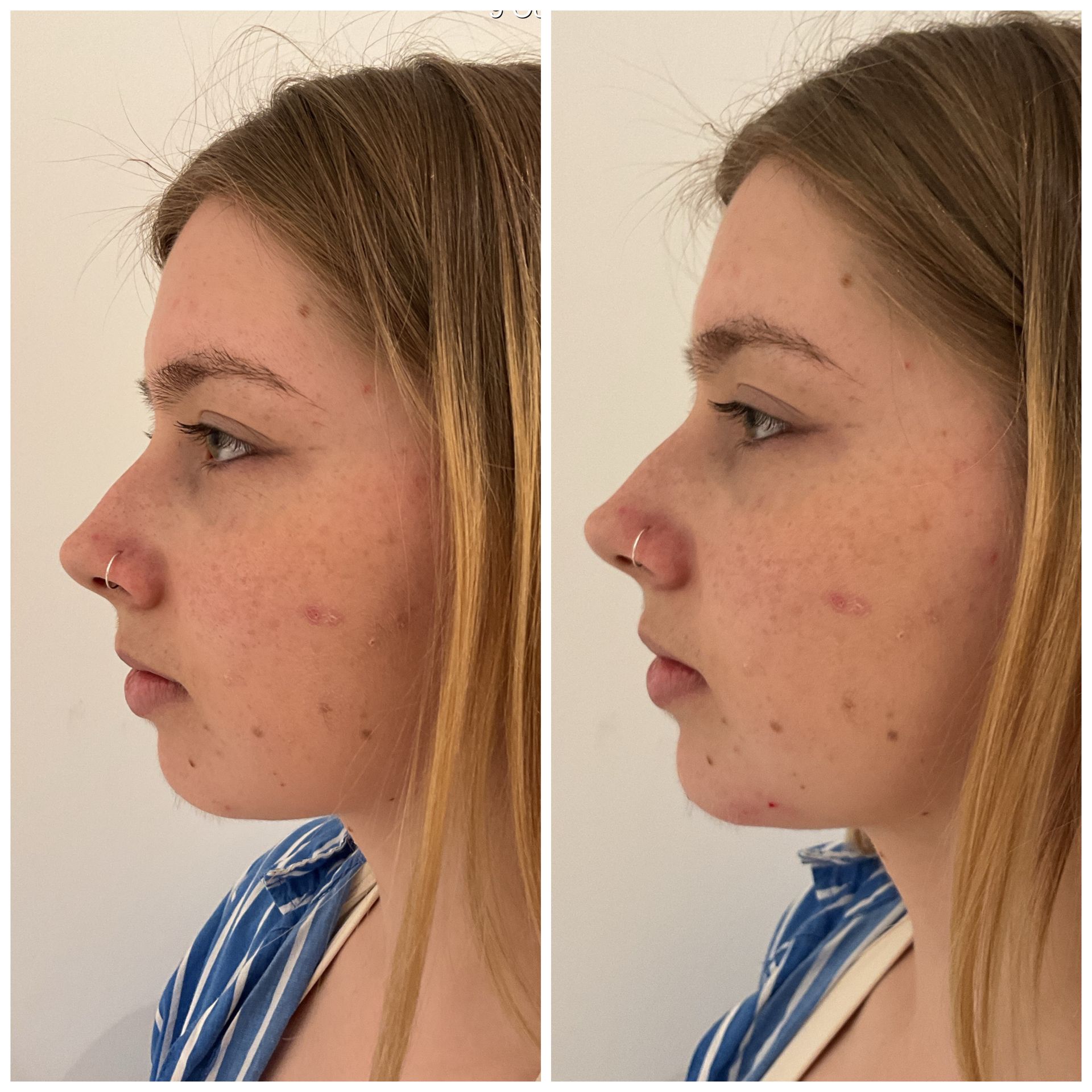Doctor-led chin filler to improve profile balance and harmony