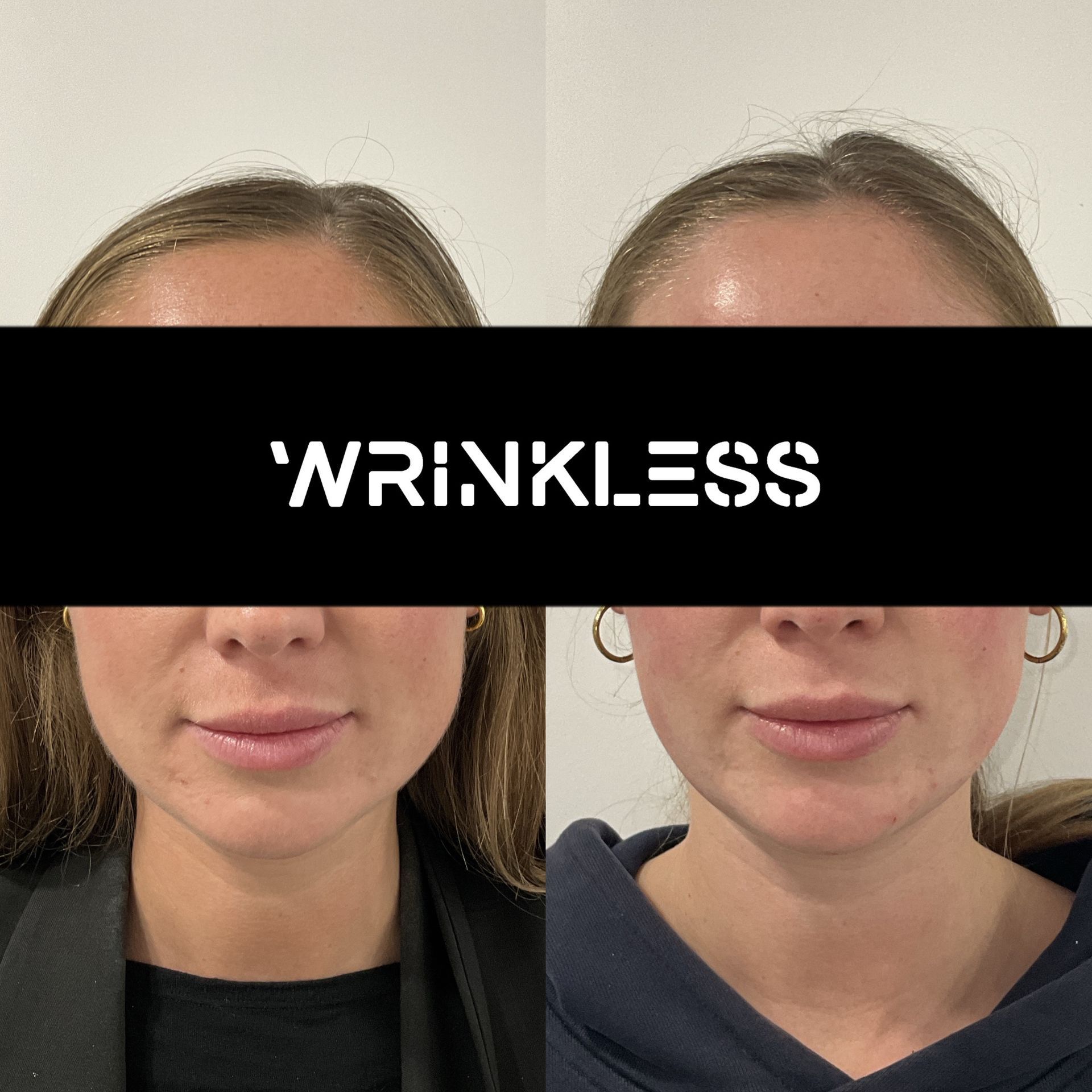 Masseter Botox treatment for jaw slimming and teeth grinding