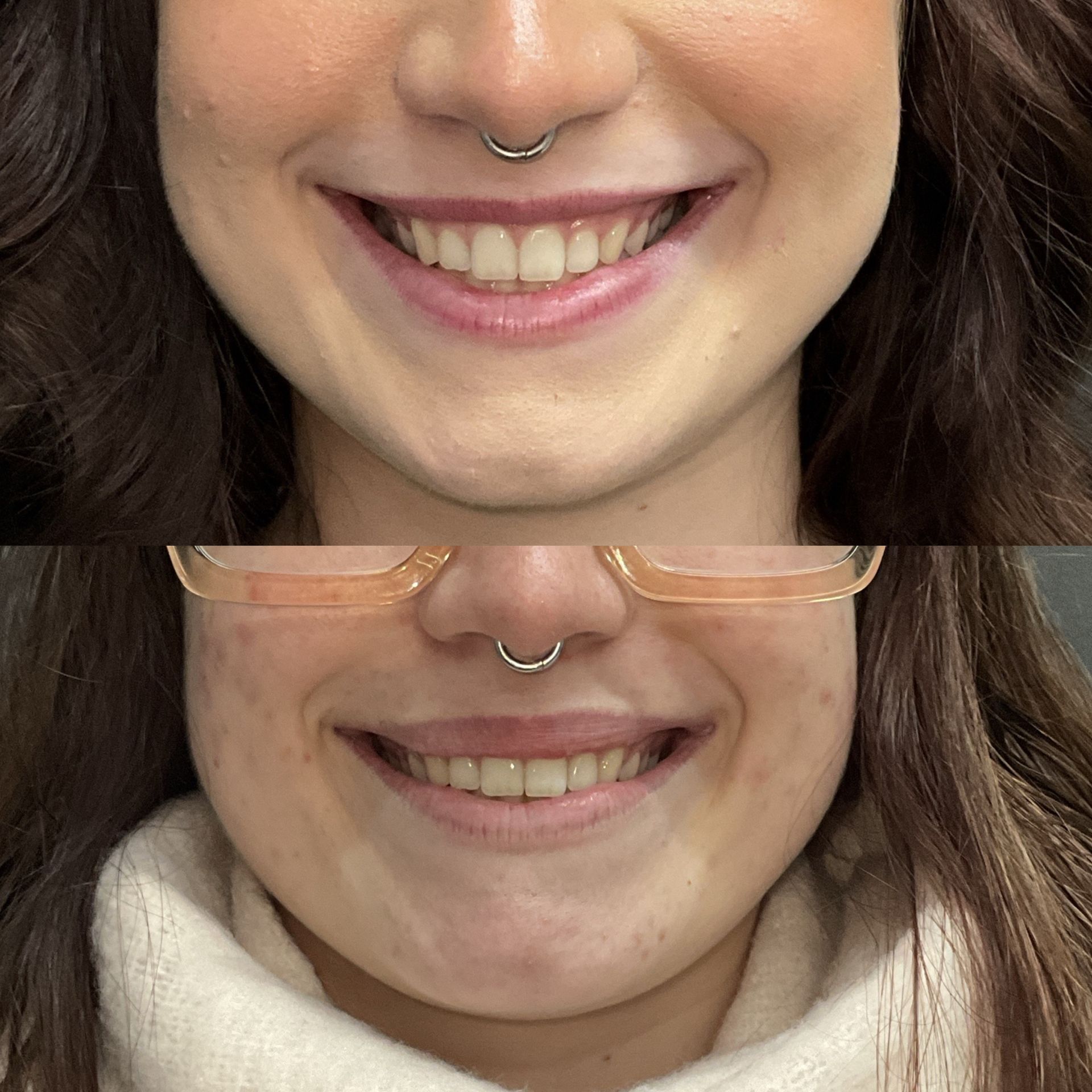 Doctor-led Botox lip flip treatment to subtly enhance the upper lip
	