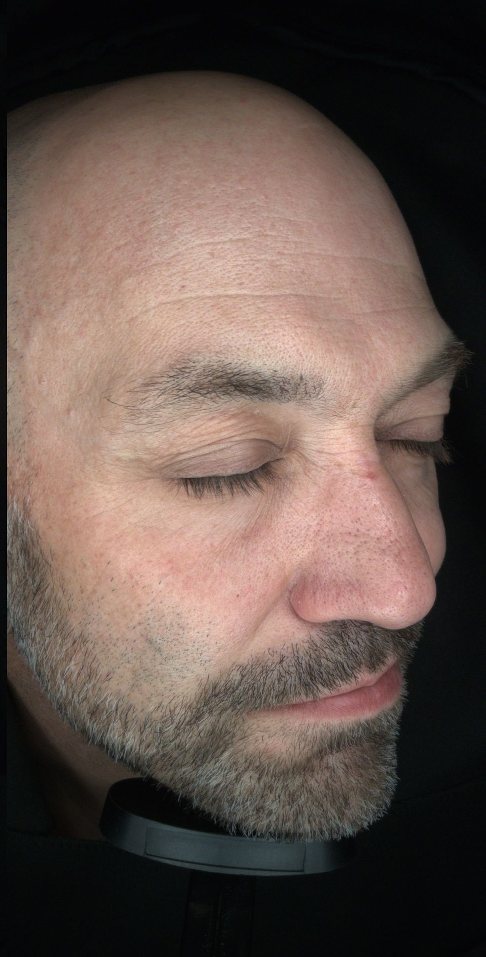 Chemical peel for skin brightening and improved complexion- before 