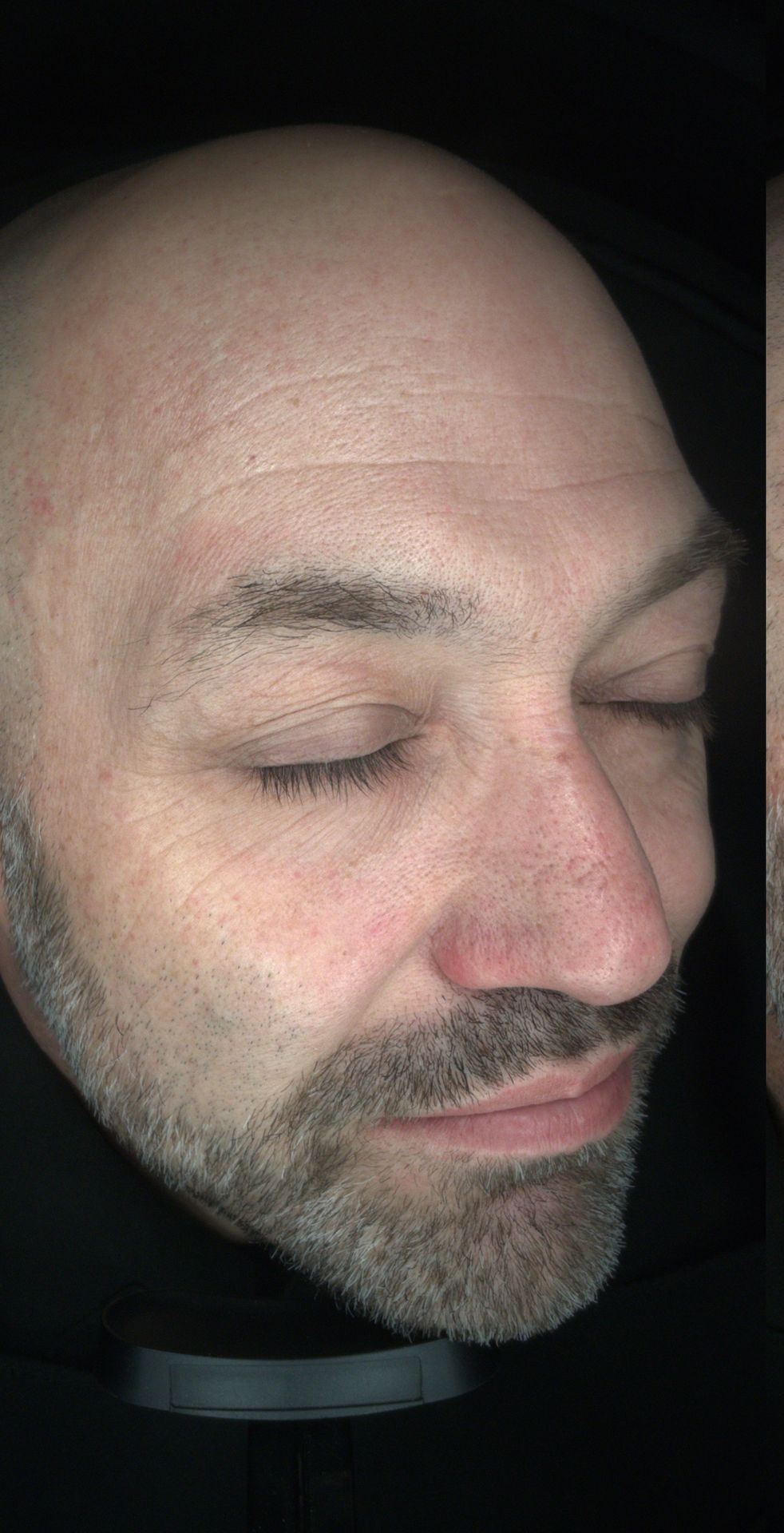 Chemical peel for skin brightening and improved complexion- before