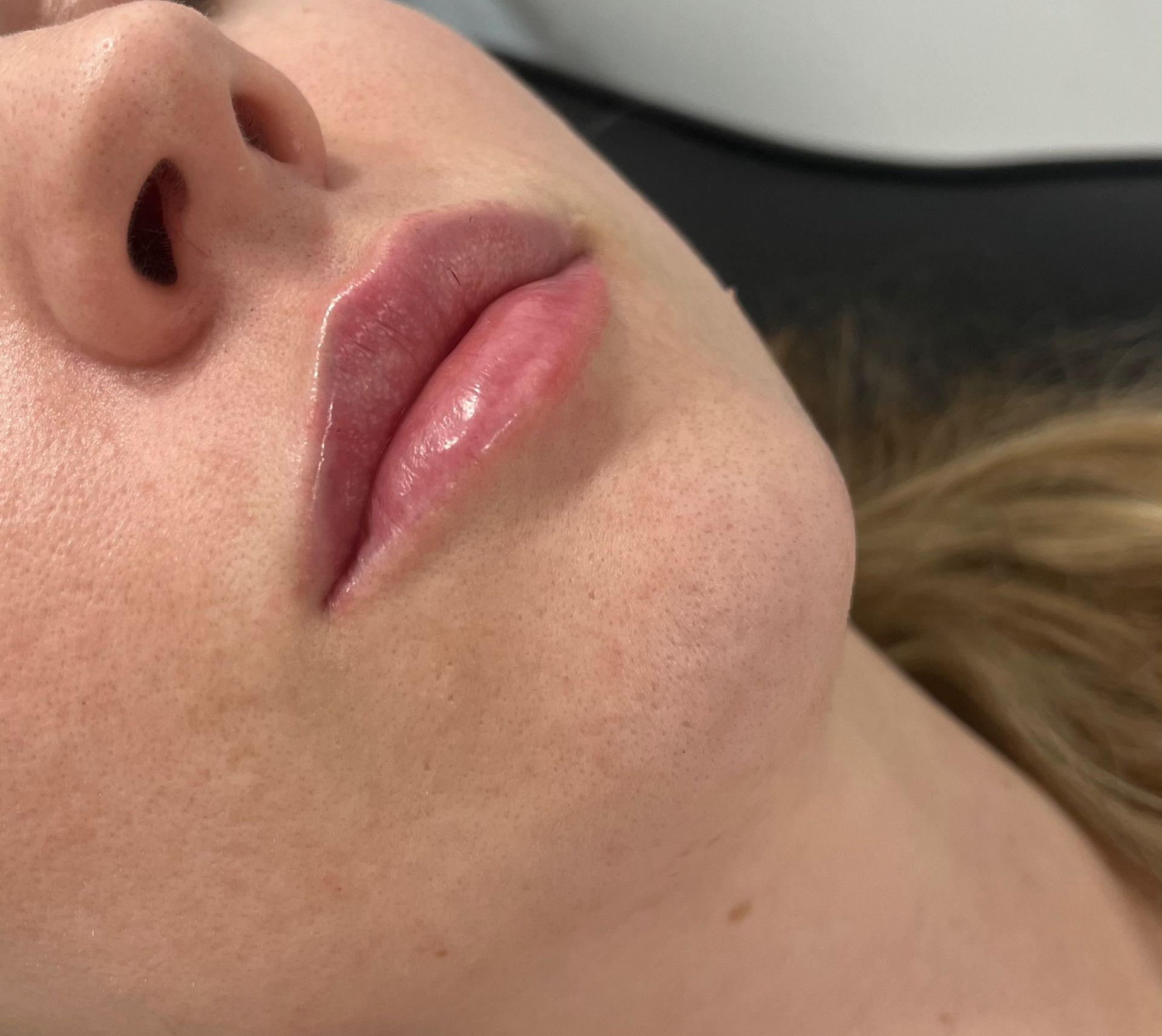 Natural lip filler results performed by a medical doctor