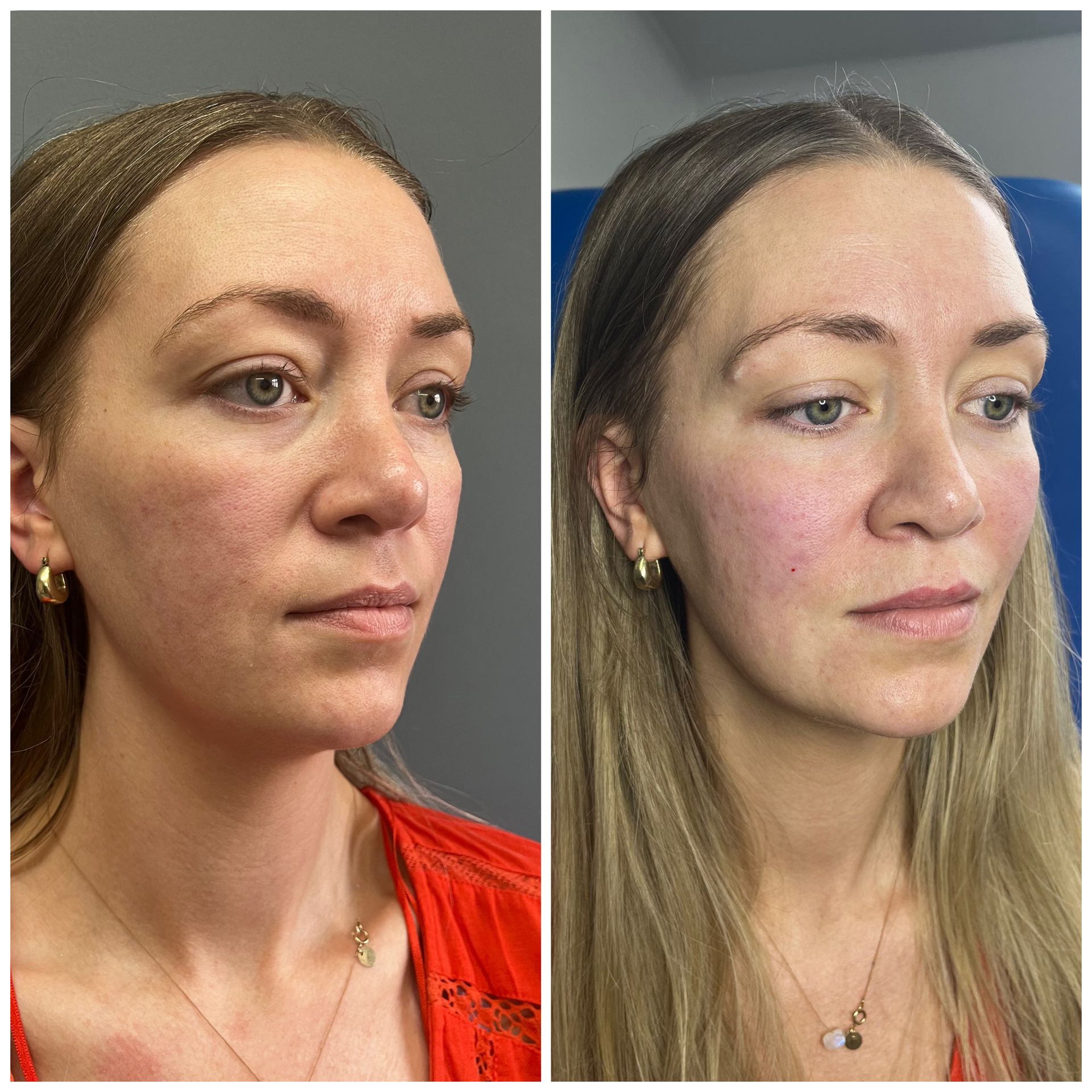 Doctor-led cheek filler to restore mid-face volume and facial balance