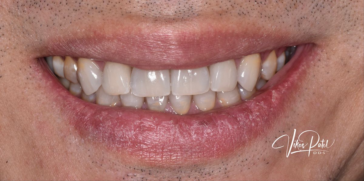 After dental procedure