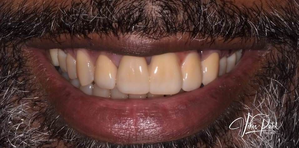 After dental procedure