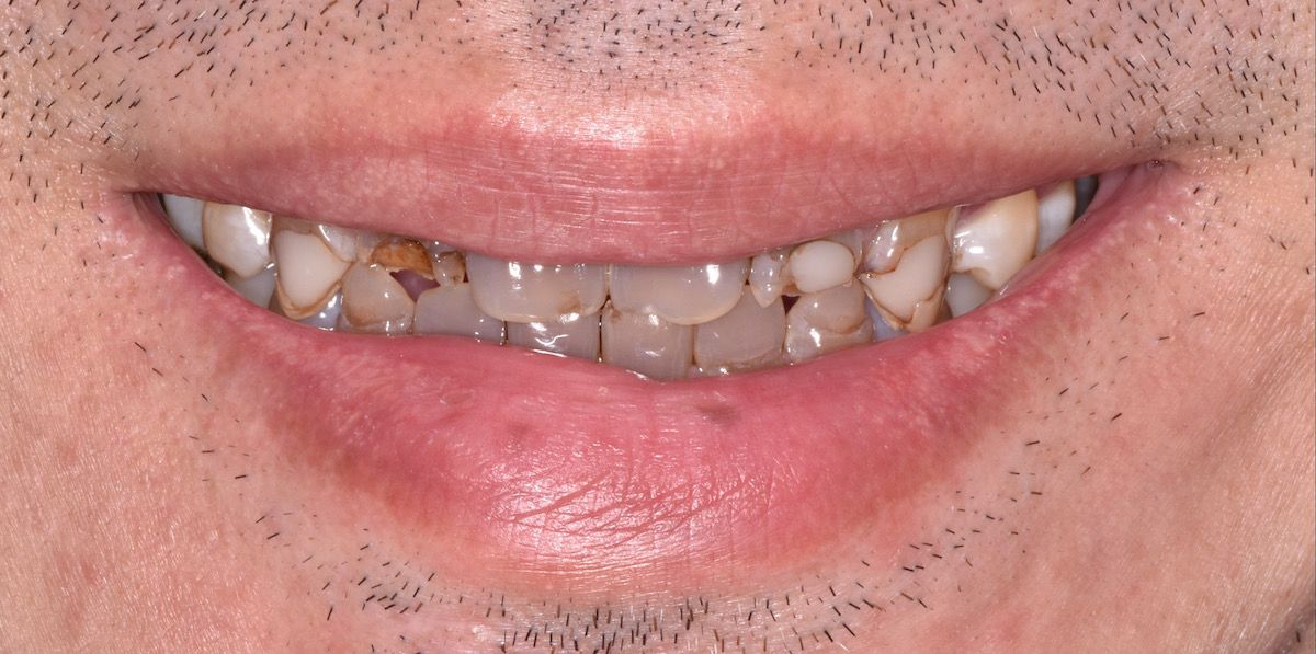 Before dental procedure