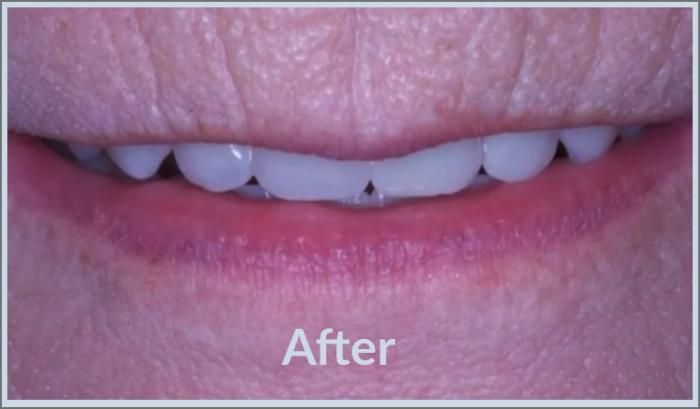 Close-up of a person's mouth with bright, even teeth after a dental procedure.