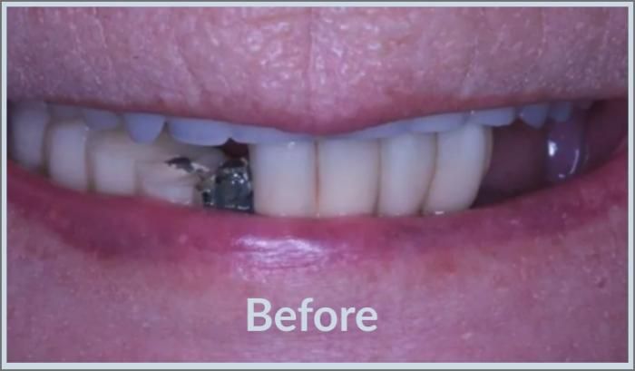 Close-up of a person's mouth with a missing tooth and a damaged tooth.
