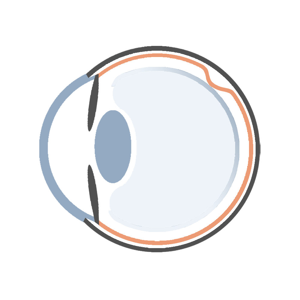 Glaskörpertraktion, Grafik