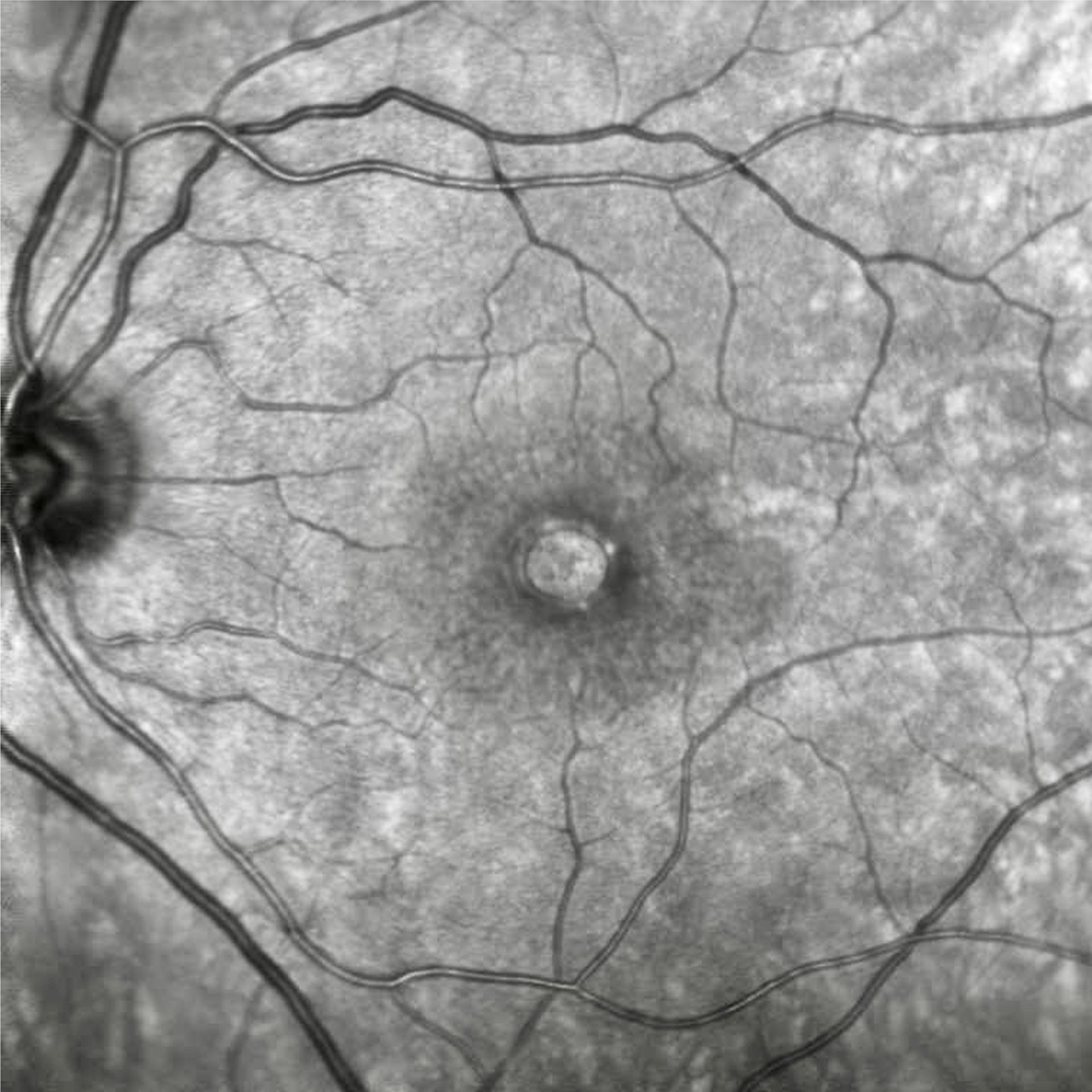 Netzhautscan und Gesichtsfeld bei Makulaforamen, Foto