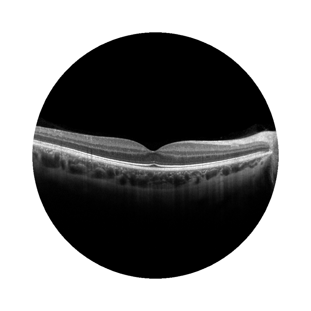 OCT der Makula, optische Kohärenztomografie, Abbildung