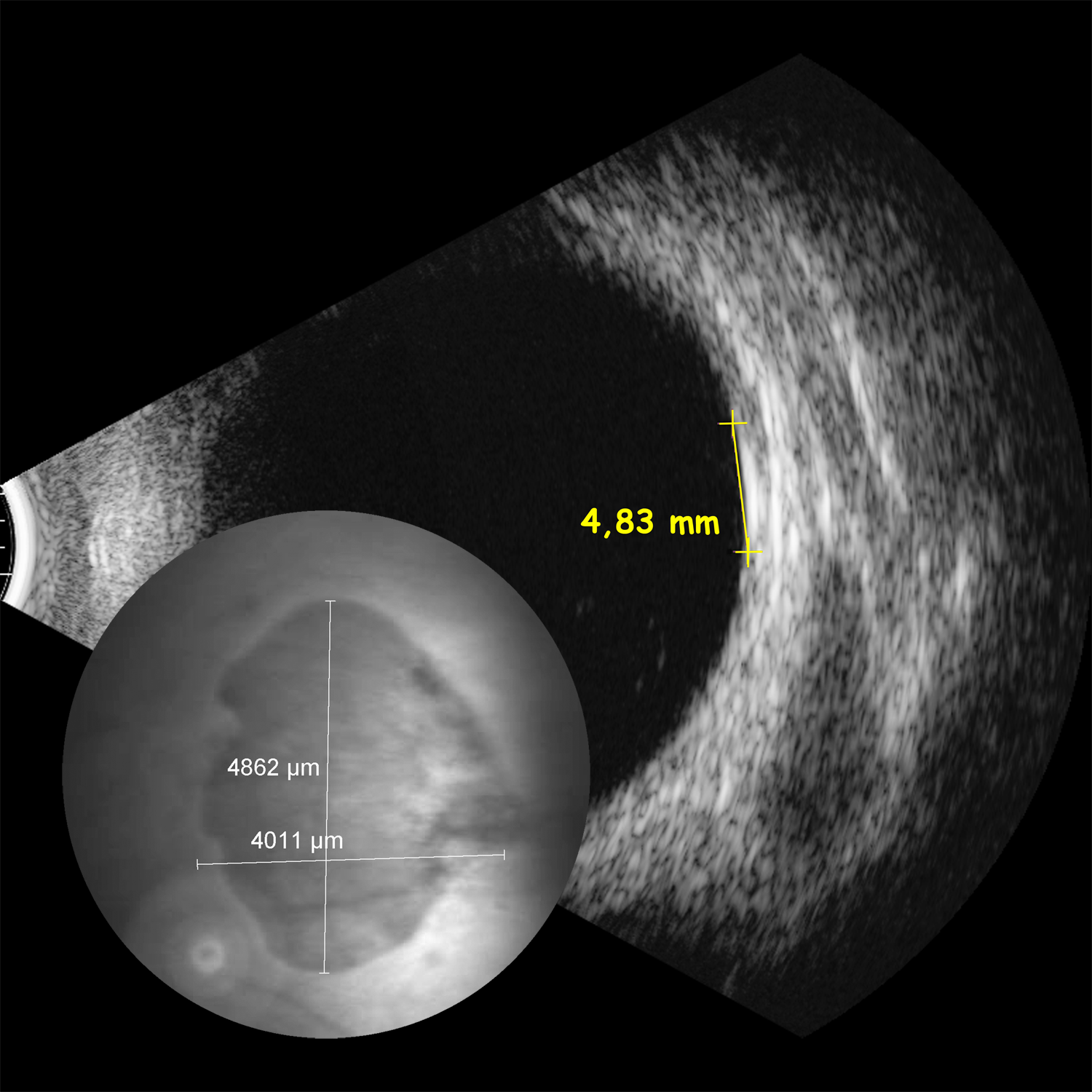 Aderhautnävus, Ultraschall, Abbildung