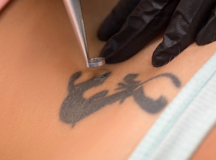 The Tattoo Removal Clinic removing a black ink tattoo