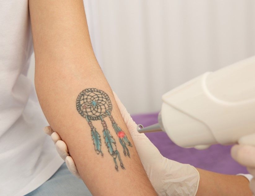 The Tattoo Removal Clinic removing a colour ink tattoo from a forearm