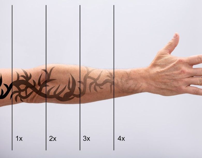 The Tattoo Removal Clinic showing the stages of laser tattoo fading