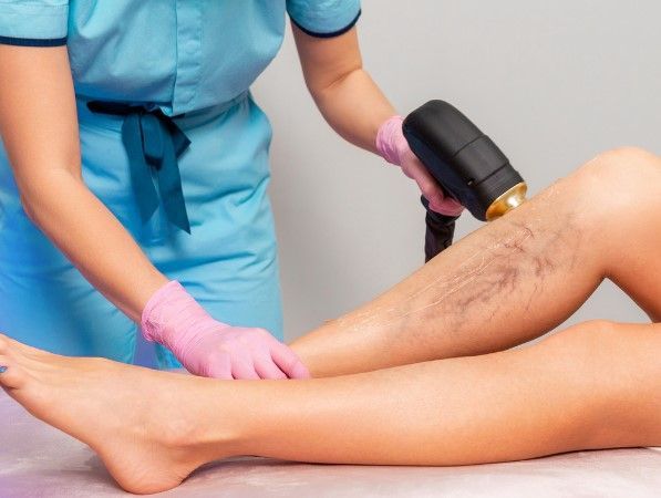 The Tattoo Removal Clinic using a laser for thread vein removal from a leg in Coventry