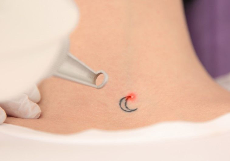 The Tattoo Removal Clinic patch testing a tattoo following a skin consultation